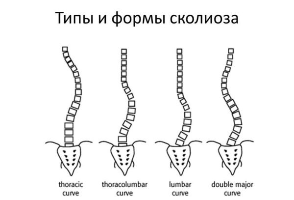 Типы и формы сколиоза